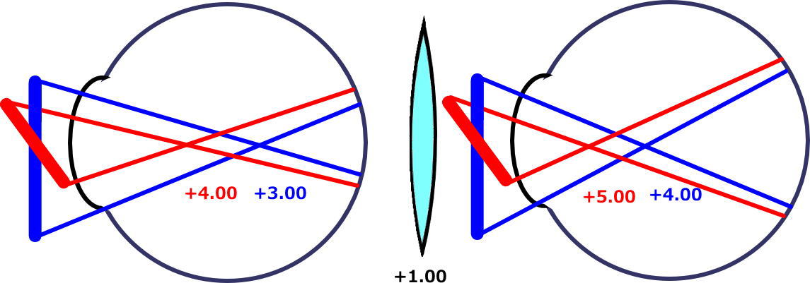 4 乱視の矯正